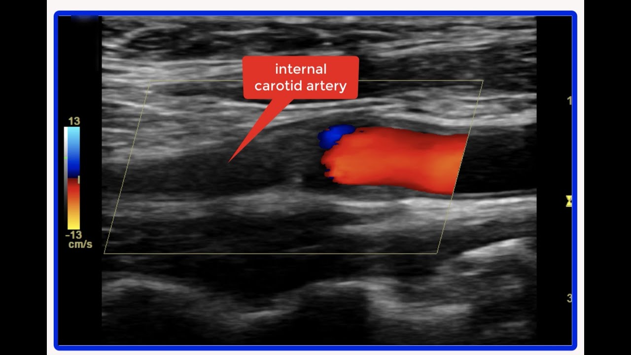 Carotid Anatomy Ultrasound